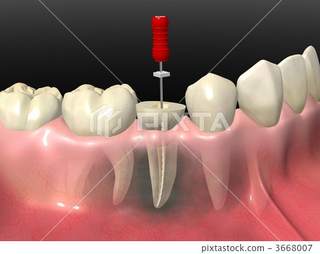 根管治療 根管治療 3668007