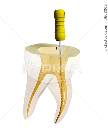 Root canal treatment 3668008