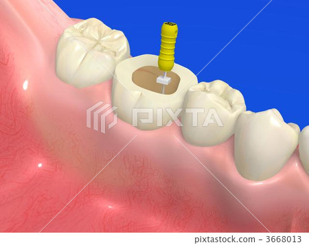 Root canal treatment 3668013