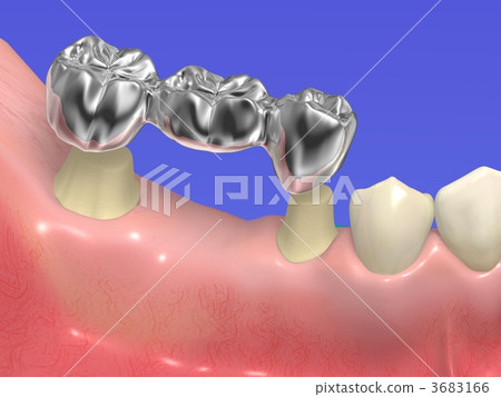 Dental treatment 3683166