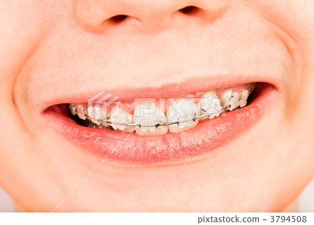 Braces Braces 3794508