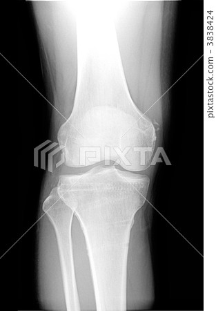 Roentgen right knee joint and shin 3838424