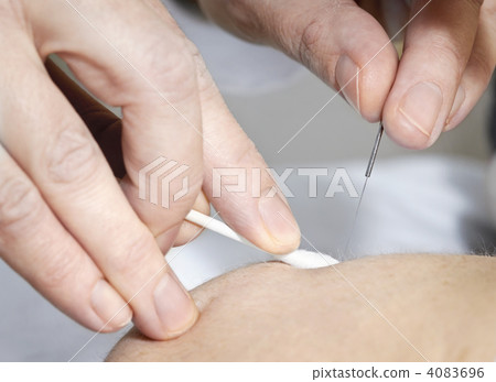 Acupuncture needle in skin Acupuncture needle in skin 4083696