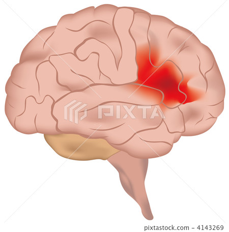Intracerebral bleeding Intracerebral bleeding 4143269