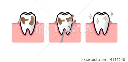 dental prophylaxis, guard against tooth decay, dental plaque 4156240