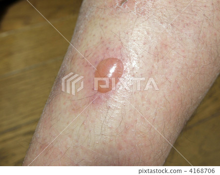 Bubbles due to cold burn in the right foot shank 4168706