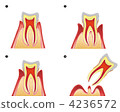 Periodontal disease 4236572