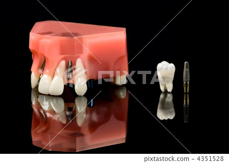 Real Human Wisdom tooth, Dental Implant and Plastic Teeth Model 4351528