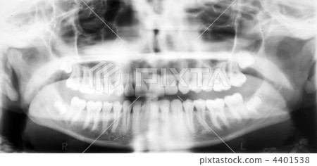 X-ray of the oral cavity. 4401538