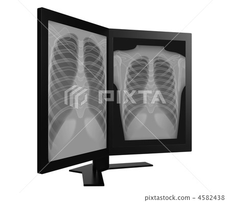 2 screen monitor and chest X-ray image (side view) 2 screen monitor and chest X-ray image (side view) 4582438