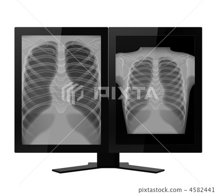 2屏幕監視器和胸部X光圖像(前視圖) 2屏幕監視器和胸部X光圖像(前視圖) 4582441