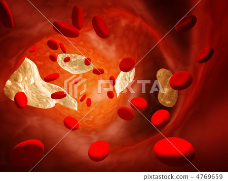 Atherosclerosis 4769659