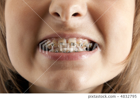 Girl smiles with bracket on teeth 4832795