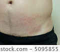 Dermatitis caused by urticaria 5095855