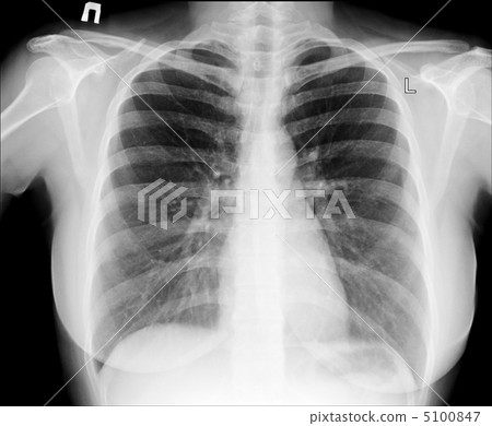 X-ray of chest 5100847