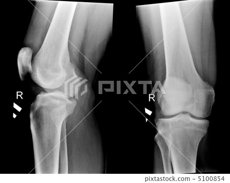 x-ray pictures of human knee joints x-ray pictures of human knee joints 5100854