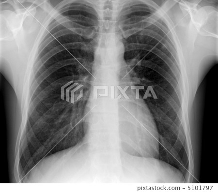 X-ray of human chest 5101797