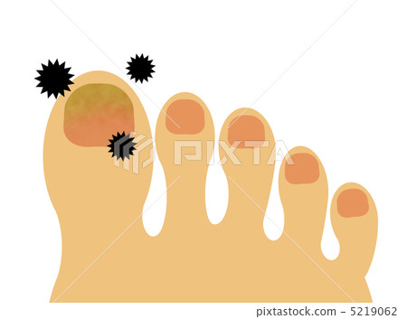 Nail athlete's foot 5219062