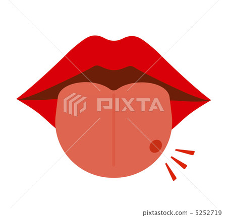 Stomatitis on the tongue 5252719