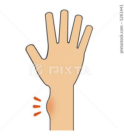 Swollen wrist Swollen wrist 5261441