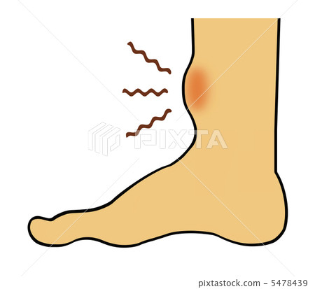 腳踝腫脹 5478439