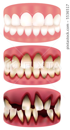 Periodontal disease progression 5536517
