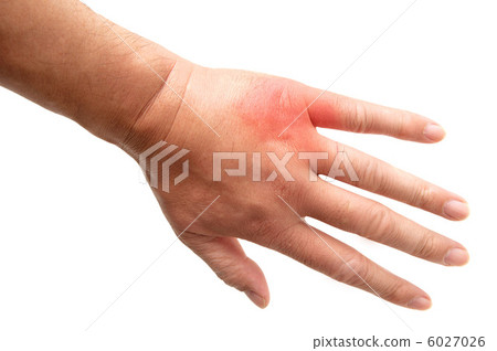 一個被昆蟲叮咬並紅腫的男人的手 6027026