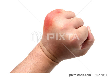 Insect bites 6027031