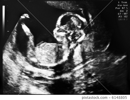 ultrasound of fetus 6148805