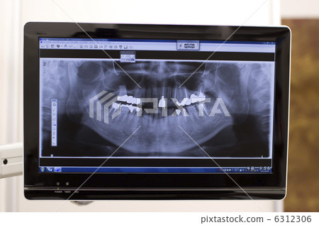 Tooth X-ray image Dental image 6312306