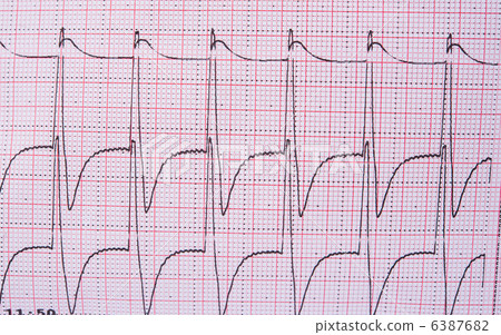 electrocardiogram of heart 6387682