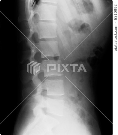 X射線腰椎 6510992