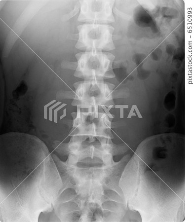 X-ray lumbar vertebra 6510993