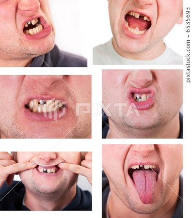 Young man face with broken tooth Young man face with broken tooth 6535693