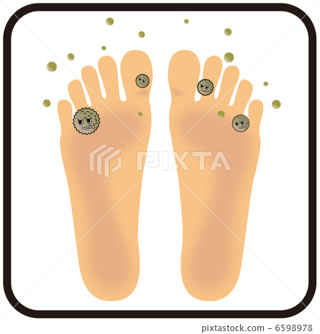 Athlete's foot (soles of feet) A-6 6598978