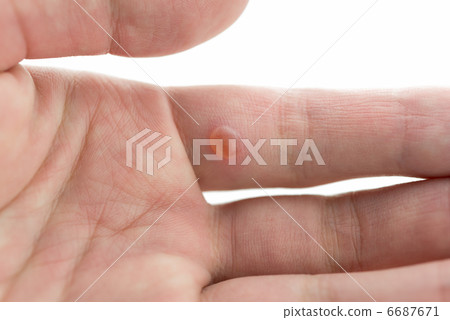 有疣的手(在與液氮的治療以後)白色背景 有疣的手(在與液氮的治療以後)白色背景 6687671