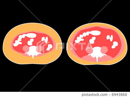 Sectional view of visceral fat and subcutaneous fat 6943668