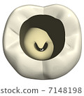 During second molar operation 7148198