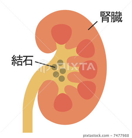 Kidney stone 7477988