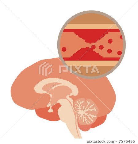 腦梗塞的風險 7576496