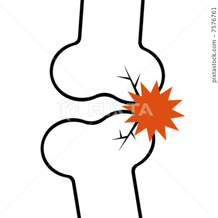 fracture 7576761