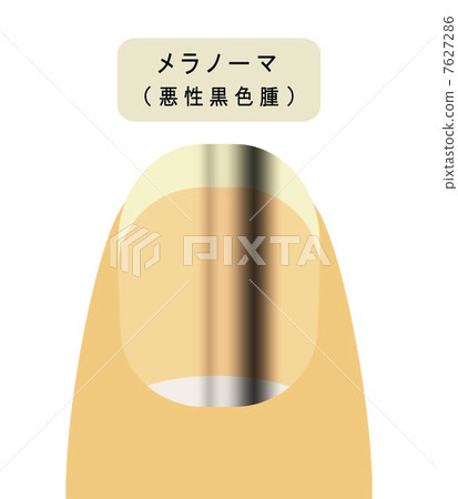 Melanoma made on nails Melanoma made on nails 7627286