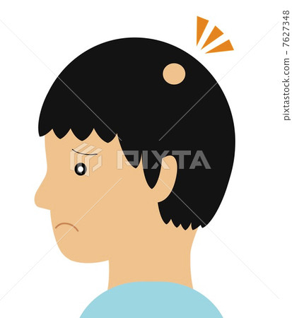 Alopecia areata 7627348