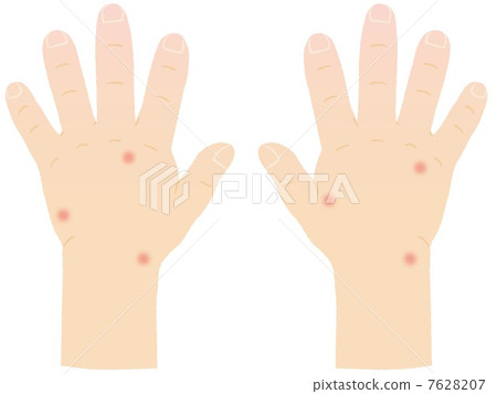 昆蟲咬手 7628207