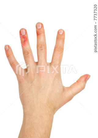 Palm with injured fingers 7737320