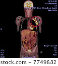 PET / CT photograph of malignant lymphoma 7749882