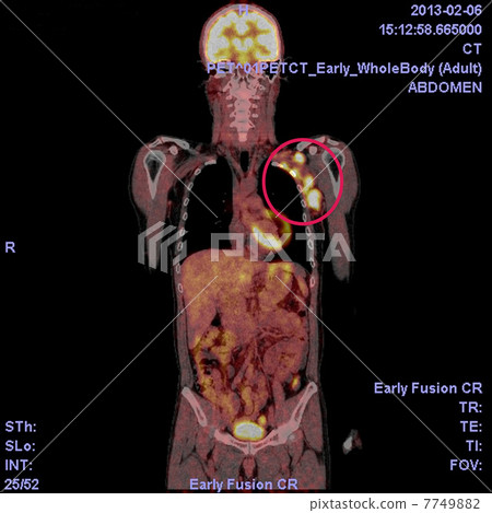 PET / CT photograph of malignant lymphoma PET / CT photograph of malignant lymphoma 7749882