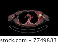 PET / CT photograph of malignant lymphoma 7749883