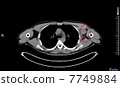 PET / CT photograph of malignant lymphoma 7749884