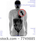 PET / CT photograph of malignant lymphoma 7749885
